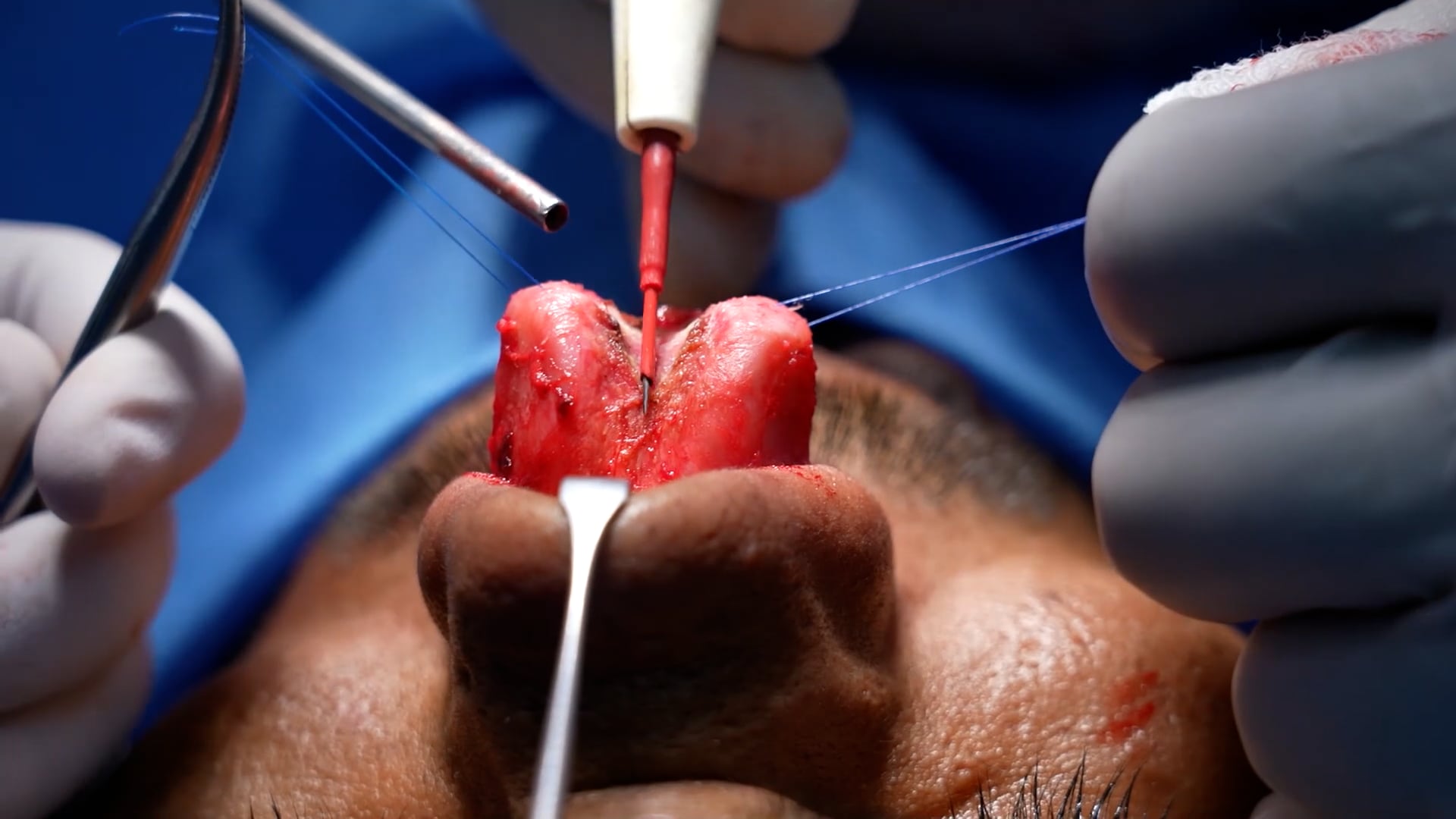 Broad and bulbous nose- Cosmetic nose surgery